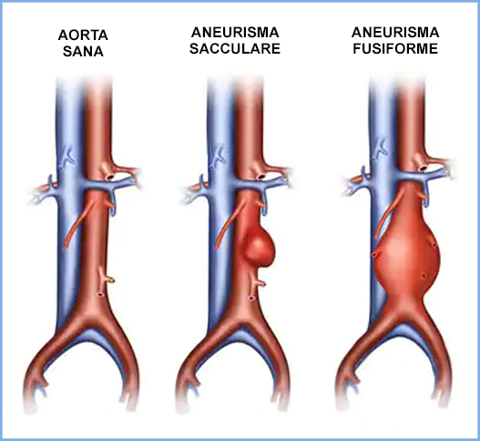 Aneurisma Aortico Addominale 1