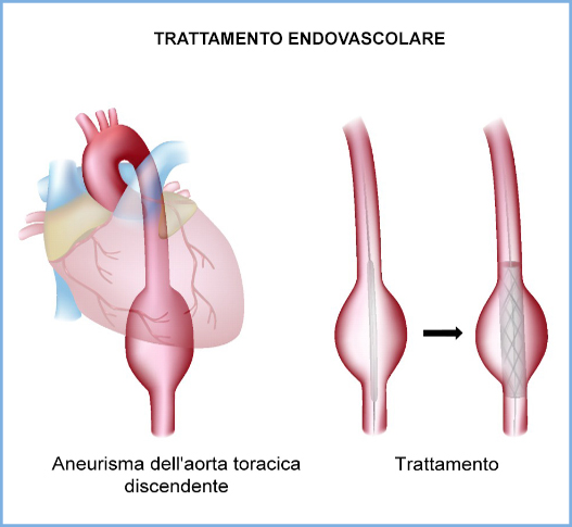 Aneurisma Aortico Addominale 2